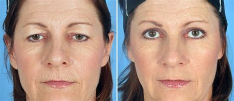 Why Eyelid Lift Surgery Consistently Tops the Charts (+ What it Can Do ...