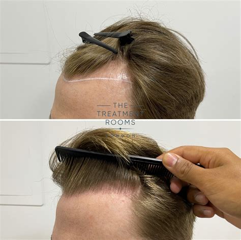 Receding Hairline & Hairline Transplant | Treatment Rooms London