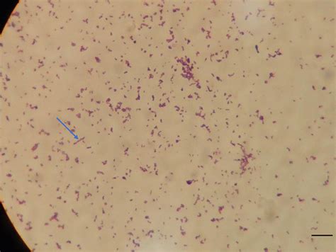 Bacterial culture of pus shows the growth of Actinomyces. Gram stain ...