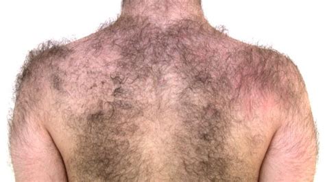 Excess Body hair - Causes, symptoms and risk factors