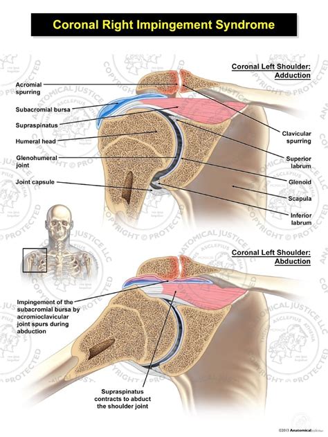 Right Coronal Impingement Syndrome