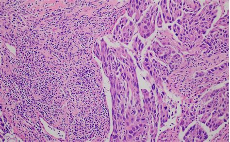 Hematoxylin-eosin staining of mucoepidermoid carcinoma. High grade... | Download Scientific Diagram