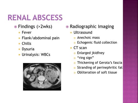 PPT - KIDNEY INFECTION PowerPoint Presentation, free download - ID:2316539