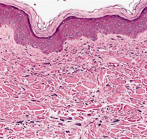 Acrochordon Histology