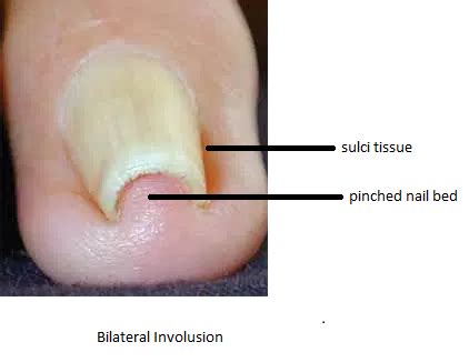 Cut Them Short Please- Painful Involuted Toenails | Erin Mills Optimum Health