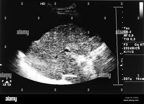 ultrasound image of liver cirrhosis and ascites Stock Photo - Alamy