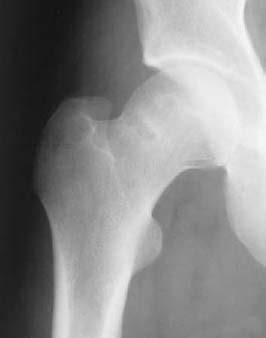 120 Synovial Herniation Pit | Radiology Key