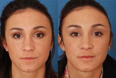 Photofacial Before & After Photos | Dr. Benjamin Bassichis