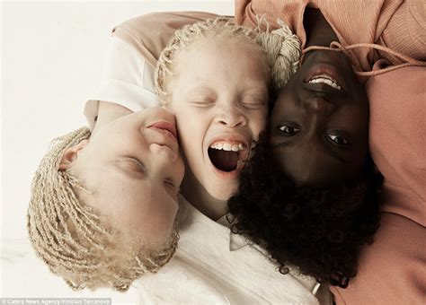 Striking looks of albino twins from Brazil | JamiiForums