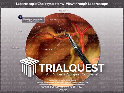 Laparoscopic Cholecystectomy - Trial Exhibits Inc.