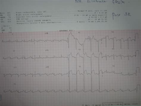 Medical Images Gallery: Anterior Wall MI ECG : ECG changes before and ...