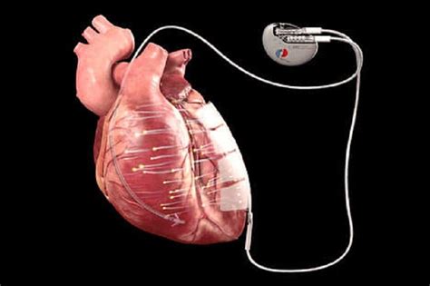 New implant uses microcurrent to strengthen heart muscle