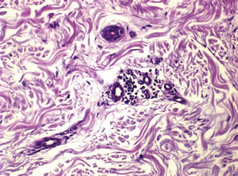 Histopathological aspects of leprosy lesions in I, TT, and LL clinical ...