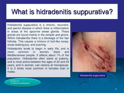 Hidradenitis suppurativa,by Dr Mohammad Baghaei