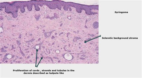 Dermpath Made Simple - Neoplastic: Syringoma