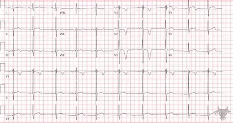 Hypertrophic Cardiomyopathy | ECG Stampede