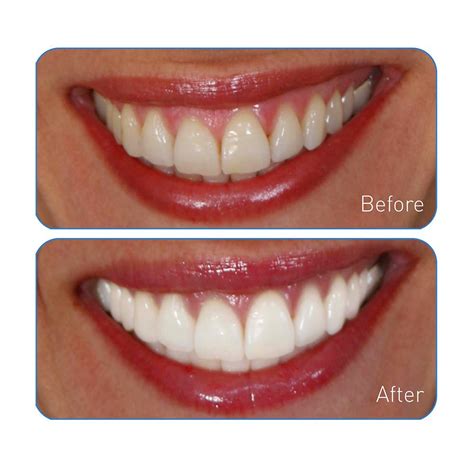 Amazon.com : Go Smile Teeth Whitening System, 20 Count : Tooth Whitening Products : Beauty