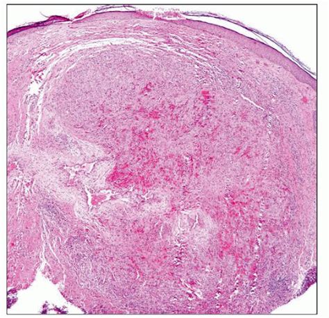 Angiolymphoid Hyperplasia with Eosinophilia | Basicmedical Key