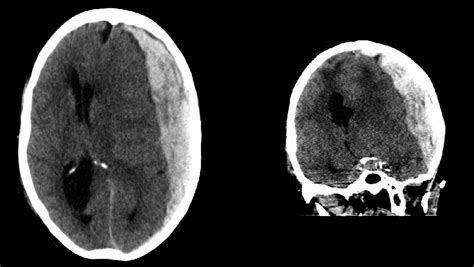 Acute Subdural Hematoma Mri | Images and Photos finder