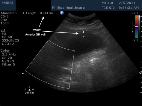 Acute Cholecystitis ~ Ultrasound Cases Info