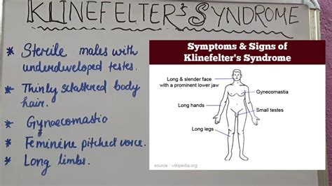 These Are The Symptoms Of Klinefelters Syndrome Medizzy | SexiezPicz ...