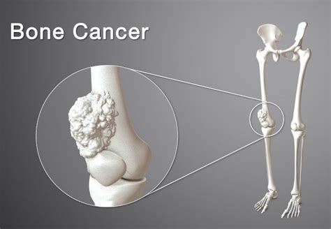 Everything about bone cancer from best cancer doctor in Delhi