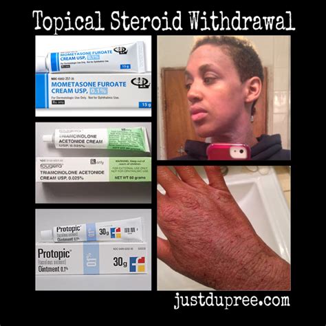 Topical Steroid Withdrawal - JUST DU PREE