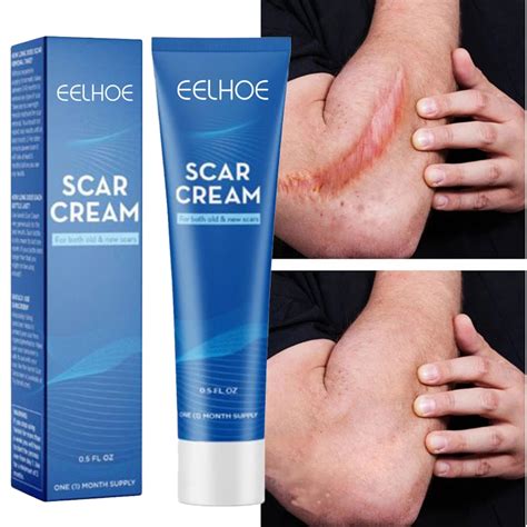 Scar Removal Cream Repairing Pock Mark Burn Surgical Scar Ce - Inspire Uplift