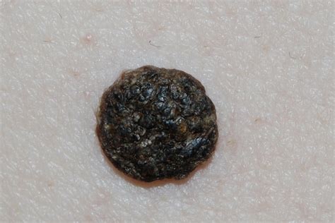 Senile warts: pictures and clinical information