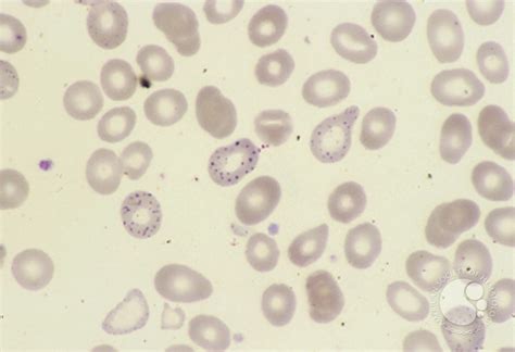 Red Blood Cell Diseases (RBC) 1 - 3.