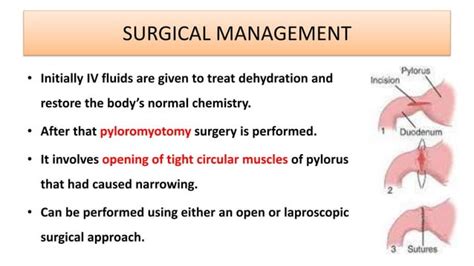 Hypertrophic Pyloric Stenosis | PPT