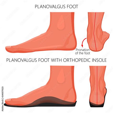 Vektorová grafika „Vector illustration of Flat or planovalgus foot without and with orthopedic ...