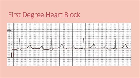 Study Medical Photos: ECG Findings In Different Types Of Heart Block.