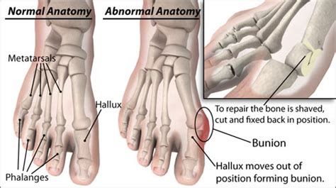 Bunion — Southeast Michigan Center for Orthopedics