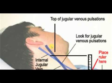 JUGULAR VENOUS PRESSURE , MEDICINE LECTURES , Cardiology Lectures , , - YouTube