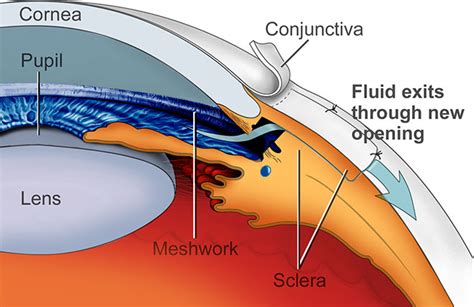 Trabeculectomy Procedure - Mitosol®