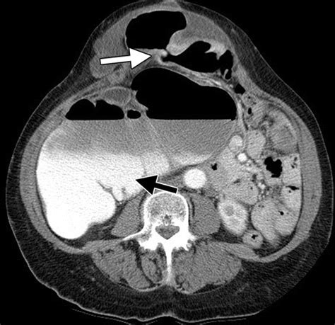 Large-Bowel Obstruction in the Adult: Classic Radiographic and CT Findings, Etiology, and Mimics ...