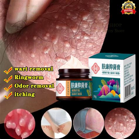 Official Authentic Itching cream Krim gatal Psoriasis Eczema cream ...