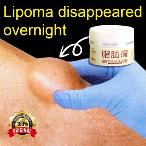 Lipoma removal Cream lipoma cream 脂肪瘤 30g Fat Granule Care Removing ...