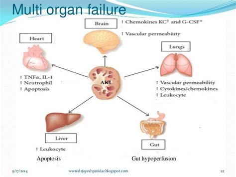 What Is Multi Organ Failure - Design Talk