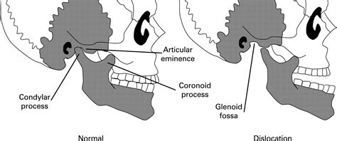 Physio for Jaw Dislocation | Pivotal Motion Physiotherapy