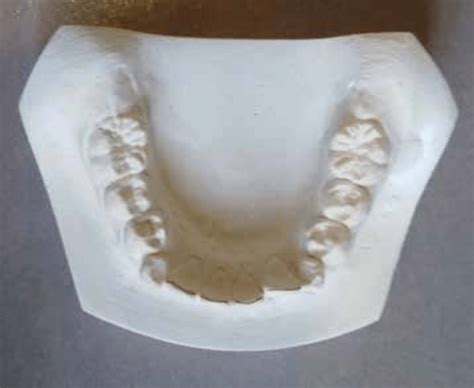 Tanaka and Johnston method for mixed dentition analysis. Tanaka and... | Download Scientific Diagram