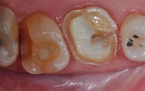 Onlay Preps-Web - Lee Ann Brady, DMD's Dental Blog