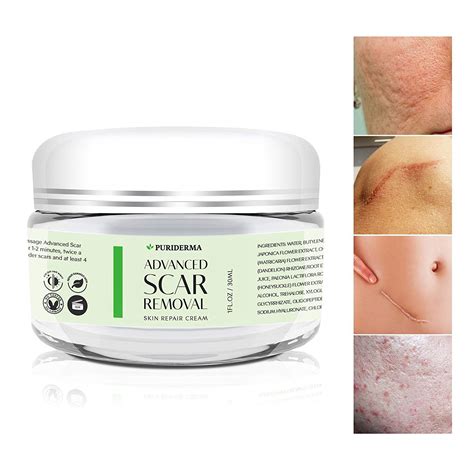 Scar Removal Cream – Advanced Treatment for Face & Body, Old & New Scars from Cuts, Stretch ...