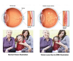 What is Macular Oedema? | Insight Eye Clinic