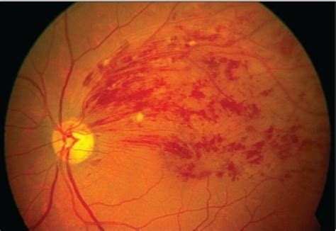 Retinal Hemorrhage; Hemorrhage, Retinal