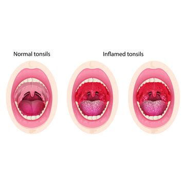 Normal Tonsils Images – Browse 149 Stock Photos, Vectors, and Video ...