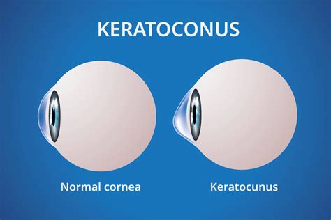 Keratoconus Corneal Transplant