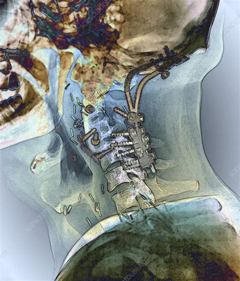 Fixed broken neck, X-ray - Stock Image - C026/9909 - Science Photo Library