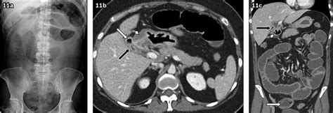 Gallstone ileus in a 39-year-old man presenting at the emergency... | Download Scientific Diagram